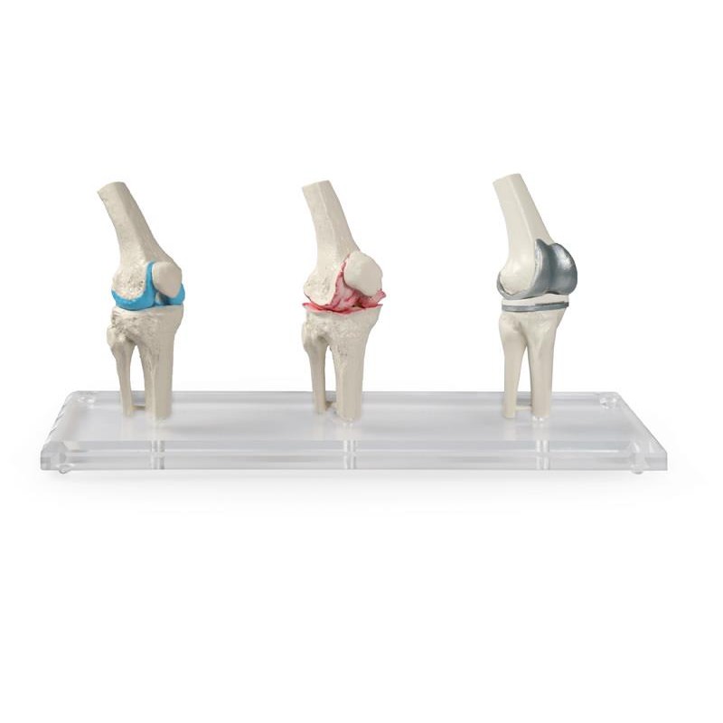 Erler-Zimmer Knee Joint Models (Set of 3)